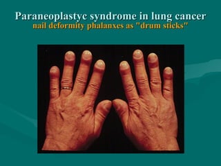 Paraneoplastyc syndrome in lung cancerParaneoplastyc syndrome in lung cancer
nail deformity phalanxes as "drum sticks"nail deformity phalanxes as "drum sticks"
 