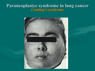 Paraneoplastyc syndrome in lung cancerParaneoplastyc syndrome in lung cancer
Cushing’s syndromeCushing’s syndrome
 