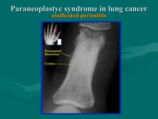 Paraneoplastyc syndrome in lung cancerParaneoplastyc syndrome in lung cancer
ossificated periostitisossificated periostitis
 