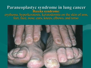 Paraneoplastyc syndrome in lung cancerParaneoplastyc syndrome in lung cancer
Bazeks syndromeBazeks syndrome::
erythema, hyperkeratosis, keratodermia on the skin of arm,erythema, hyperkeratosis, keratodermia on the skin of arm,
feet, face, nose, ears, knees, elbows, and torsofeet, face, nose, ears, knees, elbows, and torso
 