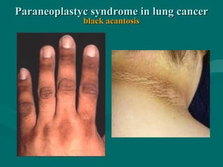 Paraneoplastyc syndrome in lung cancerParaneoplastyc syndrome in lung cancer
black acantosisblack acantosis
 