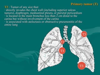 Т3
Т3
Т3
Т3
T3T3 : Tumor of any size that:: Tumor of any size that:
· directly invades the chest wall (including superior sulcus· directly invades the chest wall (including superior sulcus
tumors), diaphragm, mediastinal pleura, or parietal pericardiumtumors), diaphragm, mediastinal pleura, or parietal pericardium
· is located in the main bronchus less than 2 cm distal to the· is located in the main bronchus less than 2 cm distal to the
carina but without involvement of the carinacarina but without involvement of the carina
· is associated with atelectasis or obstructive pneumonitis of the· is associated with atelectasis or obstructive pneumonitis of the
entire lungentire lung
Primary tumor (T)Primary tumor (T)
 