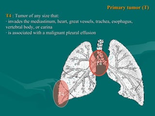 Т4
Т4
T4T4 : Tumor of any size that:: Tumor of any size that:
· invades the mediastinum, heart, great vessels, trachea, esophagus,· invades the mediastinum, heart, great vessels, trachea, esophagus,
vertebral body, or carinavertebral body, or carina
· is associated with a malignant pleural effusion· is associated with a malignant pleural effusion
Primary tumor (T)Primary tumor (T)
 