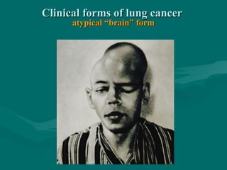 Clinical forms of lung cancerClinical forms of lung cancer
atypical “brain” formatypical “brain” form
 