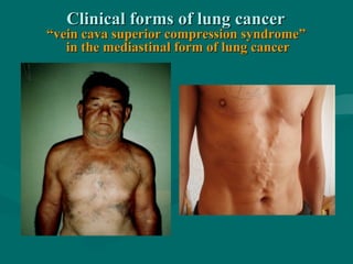 Clinical forms of lung cancerClinical forms of lung cancer
“vein cava superior compression syndrome”“vein cava superior compression syndrome”
in the mediastinal form of lung cancerin the mediastinal form of lung cancer
 