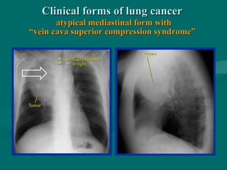 Clinical forms of lung cancerClinical forms of lung cancer
atypical mediastinal form withatypical mediastinal form with
“vein cava superior compression syndrome”“vein cava superior compression syndrome”
 