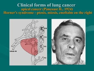 Clinical forms of lung cancerClinical forms of lung cancer
apical cancer (Pancoast H., 1924)apical cancer (Pancoast H., 1924)
Horner's syndrome - ptosis, miosis, enoftalm on the rightHorner's syndrome - ptosis, miosis, enoftalm on the right
 