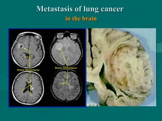 Metastasis of lung cancerMetastasis of lung cancer
in the brainin the brain
 