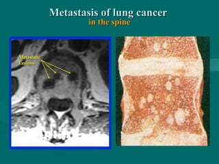 Metastasis of lung cancerMetastasis of lung cancer
in the spinein the spine
 