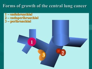 Forms of growth of the central lung cancerForms of growth of the central lung cancer
1 – endobronchial1 – endobronchial
2 – endoperibronchial2 – endoperibronchial
3 – peribronchial3 – peribronchial
1
23
 