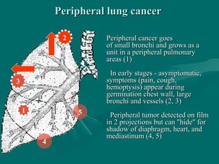 Peripheral lung cancerPeripheral lung cancer
1
3
5
2
4
Peripheral cancer goesPeripheral cancer goes
of small bronchi and grows as aof small bronchi and grows as a
unit in a peripheral pulmonaryunit in a peripheral pulmonary
areas (1)areas (1)
In early stages - asymptomatic,In early stages - asymptomatic,
symptoms (pain, cough,symptoms (pain, cough,
hemoptysis) appear duringhemoptysis) appear during
germination chest wall, largegermination chest wall, large
bronchi and vessels (2, 3)bronchi and vessels (2, 3)
Peripheral tumor detected on filmPeripheral tumor detected on film
in 2 projections but can "hide" forin 2 projections but can "hide" for
shadow of diaphragm, heart, andshadow of diaphragm, heart, and
mediastinum (4, 5)mediastinum (4, 5)
 