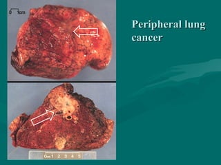 Peripheral lungPeripheral lung
cancercancer
 