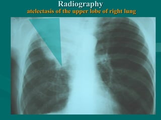 RadiographyRadiography
atelectasis of the upper lobe of right lungatelectasis of the upper lobe of right lung
 