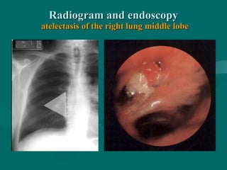Radiogram and endoscopyRadiogram and endoscopy
atelectasis of the right lung middle lobeatelectasis of the right lung middle lobe
 