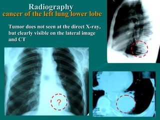 RadiographyRadiography
cancer of the left lung lower lobecancer of the left lung lower lobe
?
Tumor does not seen at the direct X-ray,Tumor does not seen at the direct X-ray,
but clearly visible on the lateral imagebut clearly visible on the lateral image
and CTand CT
 