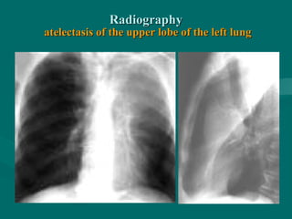 RadiographyRadiography
atelectasis of the upper lobe of the left lungatelectasis of the upper lobe of the left lung
 