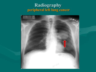 RadiographyRadiography
peripheral left lung cancerperipheral left lung cancer
 
