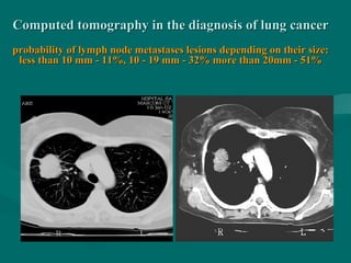 Computed tomography in the diagnosis of lung cancerComputed tomography in the diagnosis of lung cancer
probability of lymph node metastases lesions depending on their size:probability of lymph node metastases lesions depending on their size:
less than 10 mm - 11%, 10 - 19 mm - 32% more than 20mm - 51%less than 10 mm - 11%, 10 - 19 mm - 32% more than 20mm - 51%
 