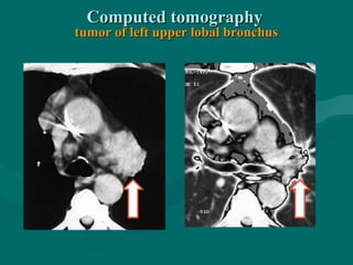 Computed tomographyComputed tomography
tumor of left upper lobal bronchustumor of left upper lobal bronchus
 