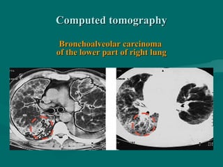 Computed tomographyComputed tomography
Bronchoalveolar carcinomaBronchoalveolar carcinoma
of the lower part of right lungof the lower part of right lung
 