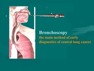 • Докторna.byДокторna.by
Bronchoscopy
the main method of early
diagnostics of central lung cancer
 
