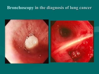 Bronchoscopy in the diagnosis of lung cancerin the diagnosis of lung cancer
 