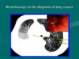 Bronchoscopy in the diagnosis of lung cancerBronchoscopy in the diagnosis of lung cancer
 