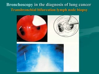 Bronchoscopy in the diagnosis of lung cancerin the diagnosis of lung cancer
Transbronchial bifurcation lymph node biopsyTransbronchial bifurcation lymph node biopsy
 