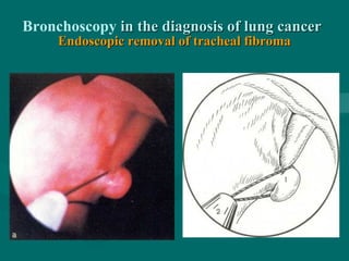 Bronchoscopy in the diagnosis of lung cancerin the diagnosis of lung cancer
Endoscopic removal of tracheal fibromaEndoscopic removal of tracheal fibroma
 