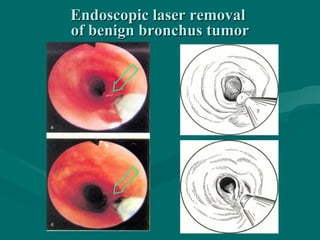 Endoscopic laser removalEndoscopic laser removal
of benign bronchus tumorof benign bronchus tumor
 