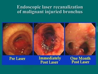 Endoscopic laser recanalizationEndoscopic laser recanalization
of malignant injuried bronchusof malignant injuried bronchus
 