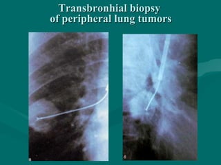 Transbronhial biopsyTransbronhial biopsy
of peripheral lung tumorsof peripheral lung tumors
 