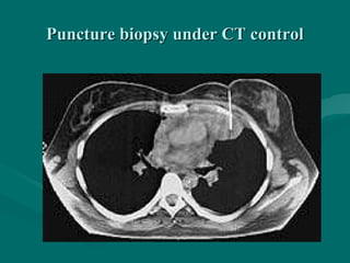 Puncture biopsy under CT controlPuncture biopsy under CT control
 