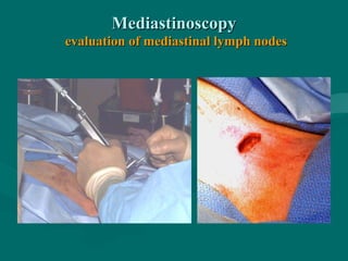 MediastinoscopyMediastinoscopy
evaluation of mediastinal lymph nodesevaluation of mediastinal lymph nodes
 