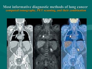 Most informative diagnostic methods of lung cancerMost informative diagnostic methods of lung cancer
computed tomography, PET scanning, and their combinationcomputed tomography, PET scanning, and their combination
 