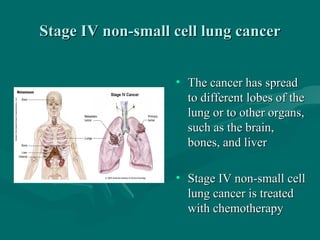 Stage IV non-small cell lung cancerStage IV non-small cell lung cancer
• The cancer has spreadThe cancer has spread
to different lobes of theto different lobes of the
lung or to other organs,lung or to other organs,
such as the brain,such as the brain,
bones, and liverbones, and liver
• Stage IV non-small cellStage IV non-small cell
lung cancer is treatedlung cancer is treated
with chemotherapywith chemotherapy
 