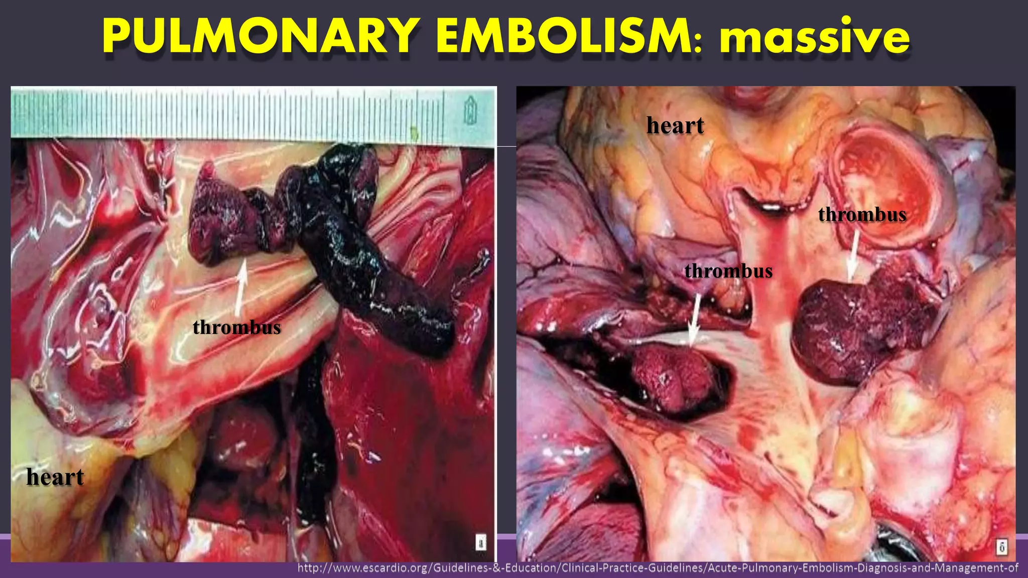 PULMONARY EMBOLISM: massive
thrombus
thrombus
thrombus
heart
heart
 