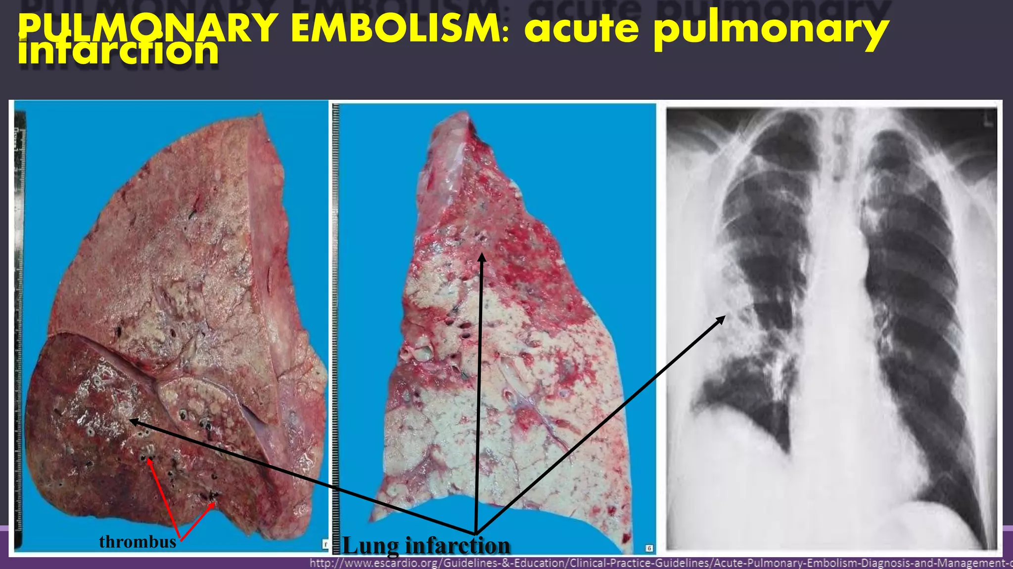 PULMONARY EMBOLISM: acute pulmonaryinfarction
Lung infarctionthrombus
 