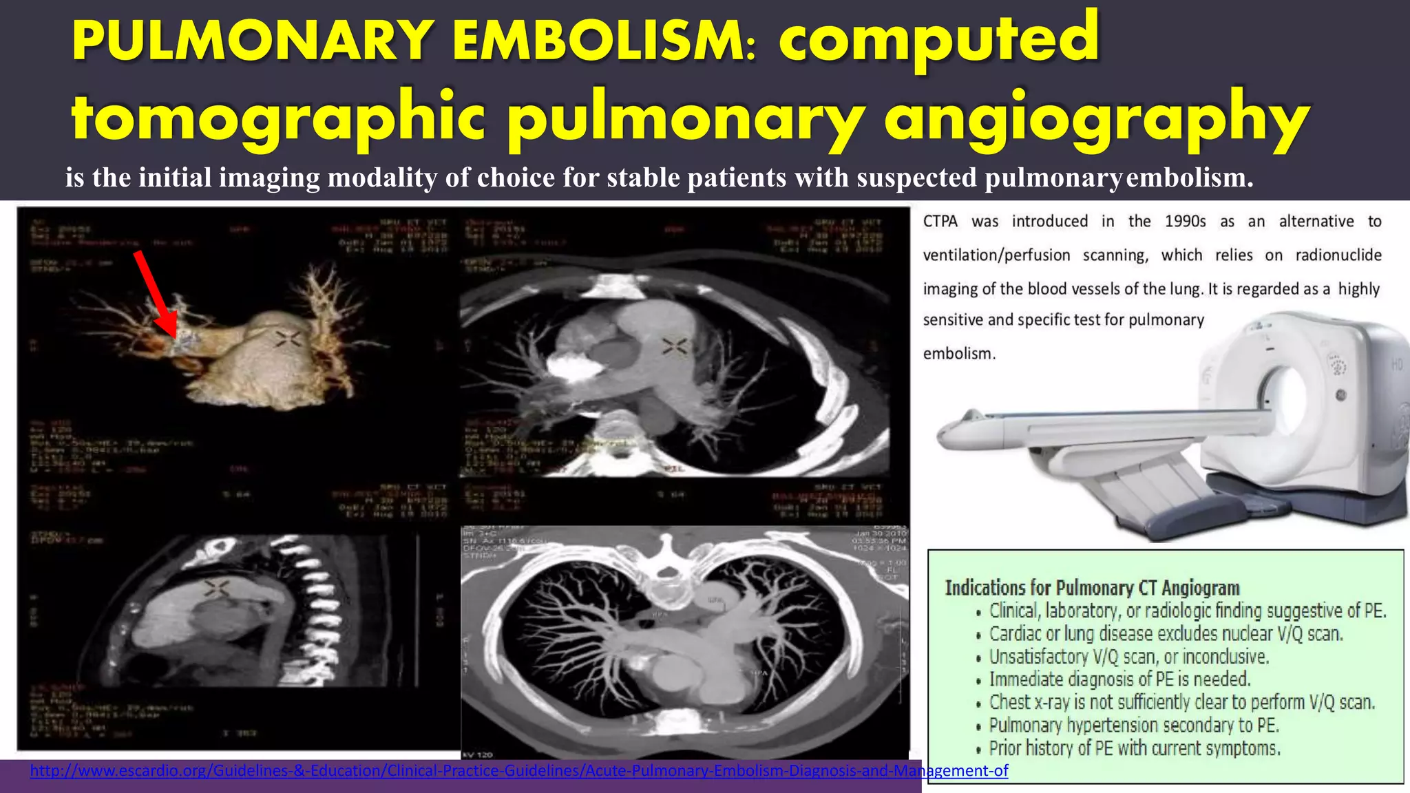 PULMONARY EMBOLISM: computed
tomographic pulmonary angiography
is the initial imaging modality of choice for stable patients with suspected pulmonaryembolism.
http://www.escardio.org/Guidelines-&-Education/Clinical-Practice-Guidelines/Acute-Pulmonary-Embolism-Diagnosis-and-Management-of
 