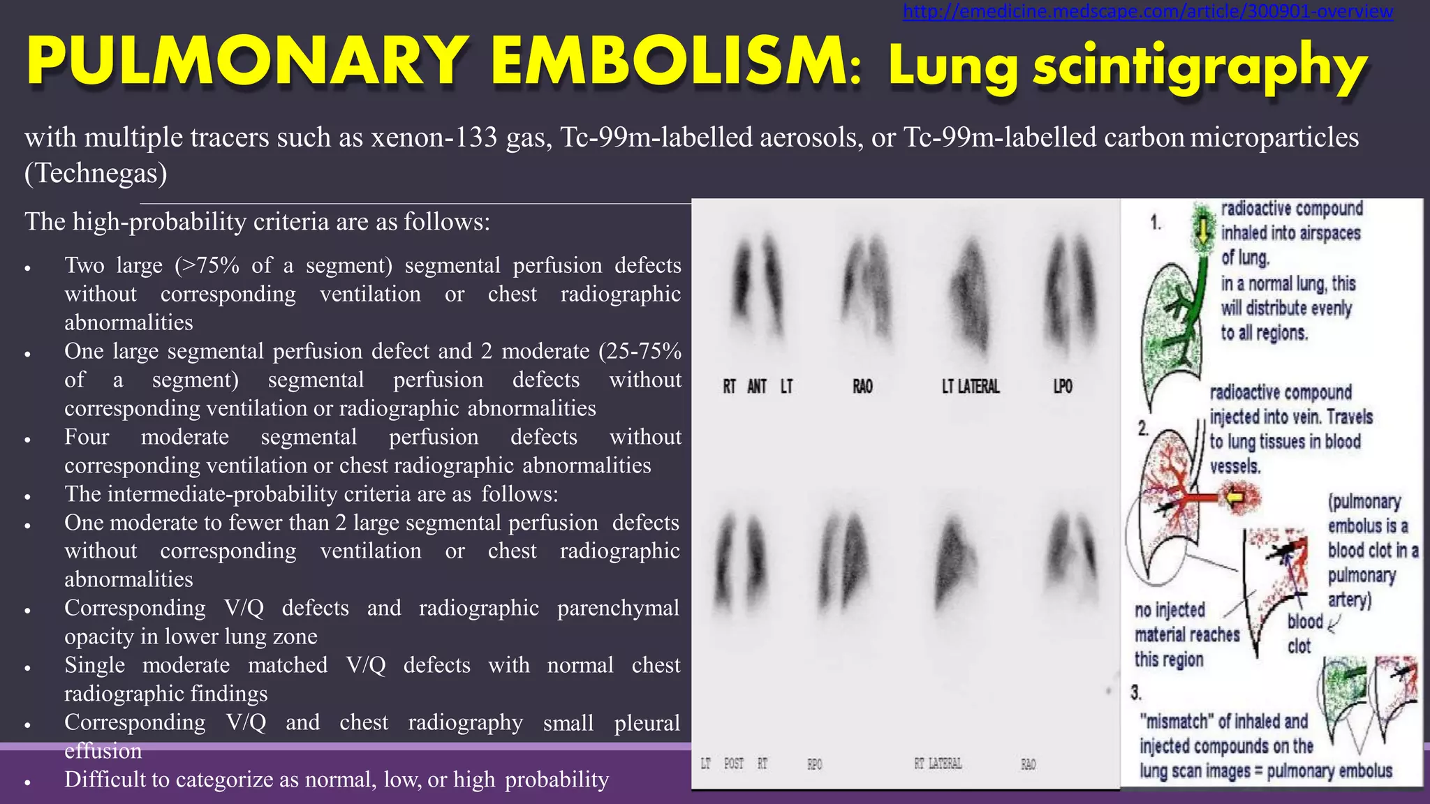 PULMONARY EMBOLISM: Lung scintigraphy
with multiple tracers such as xenon-133 gas, Tc-99m-labelled aerosols, or Tc-99m-labelled carbon microparticles
(Technegas)
The high-probability criteria are as follows:
 Two large (>75% of a segment) segmental perfusion defects
without corresponding ventilation or chest radiographic
abnormalities
 One large segmental perfusion defect and 2 moderate (25-75%
of a segment) segmental perfusion defects without
corresponding ventilation or radiographic abnormalities
 Four moderate segmental perfusion defects without
corresponding ventilation or chest radiographic abnormalities
 The intermediate-probability criteria are as follows:
 One moderate to fewer than 2 large segmental perfusion defects
radiographic
parenchymal
normal chest
small pleural
without corresponding ventilation or chest
abnormalities
 Corresponding V/Q defects and radiographic
opacity in lower lung zone
 Single moderate matched V/Q defects with
radiographic findings
 Corresponding V/Q and chest radiography
effusion
 Difficult to categorize as normal, low, or high probability
http://emedicine.medscape.com/article/300901-overview
 