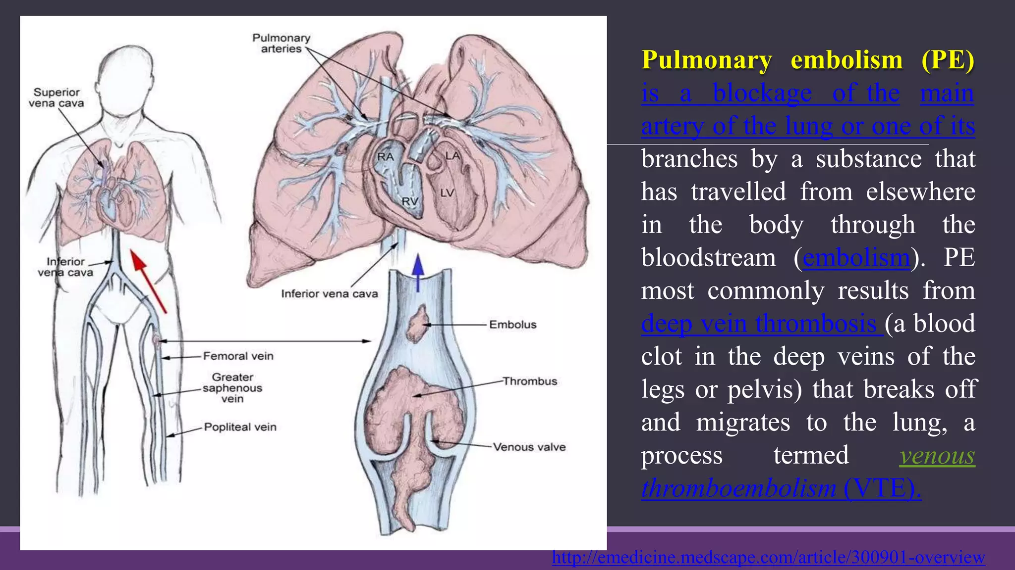 Pulmonary embolism (PE)
mainis a blockage of the
artery of the lung or one of its
branches by a substance that
has travelled from elsewhere
in the body through the
bloodstream (embolism). PE
most commonly results from
deep vein thrombosis (a blood
clot in the deep veins of the
legs or pelvis) that breaks off
and migrates to the lung, a
process termed venous
thromboembolism (VTE).
http://emedicine.medscape.com/article/300901-overview
 