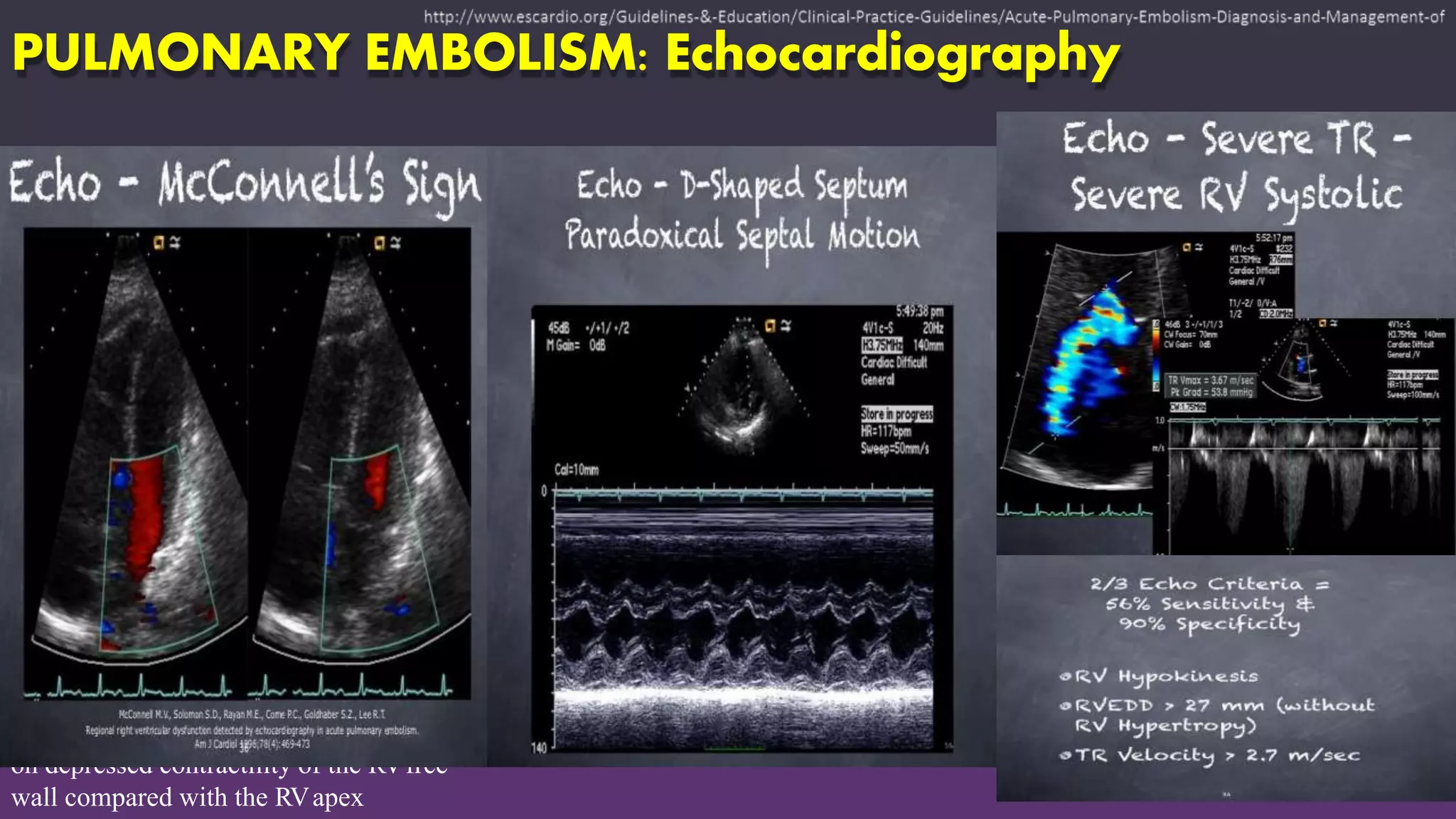 PULMONARY EMBOLISM: Echocardiography
on depressed contractility of the RVfree
wall compared with the RVapex
 