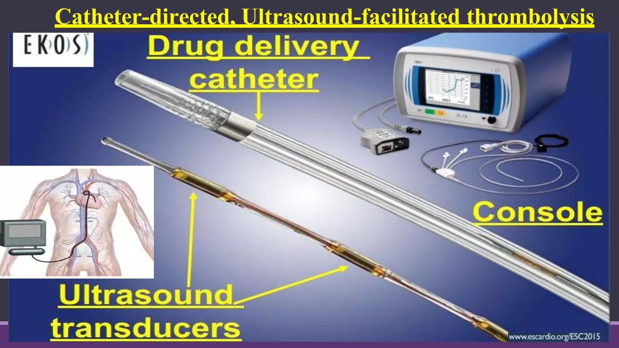 Catheter-directed, Ultrasound-facilitated thrombolysis
 