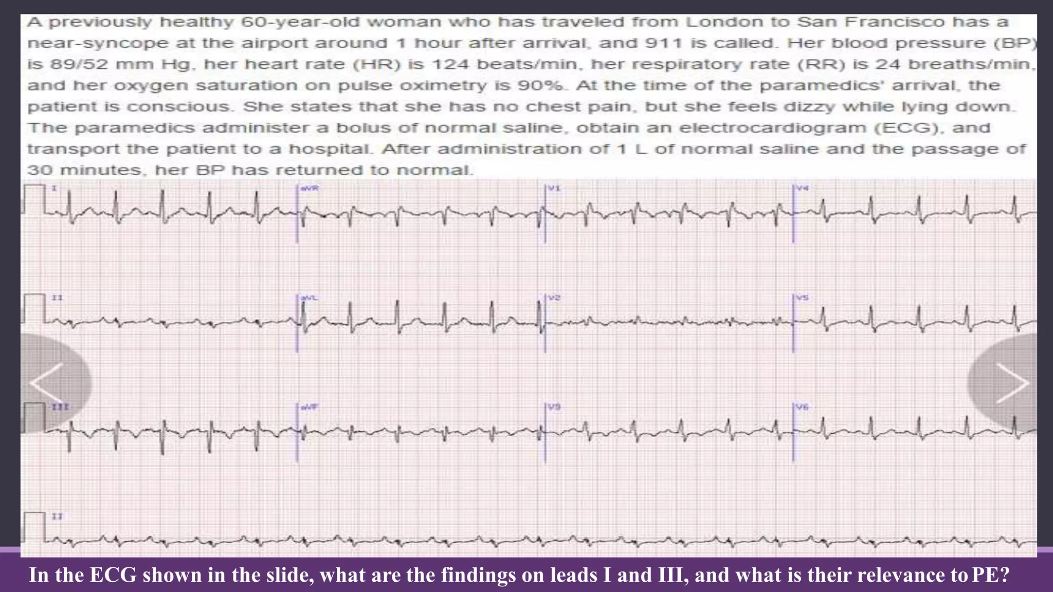 In the ECG shown in the slide, what are the findings on leads I and III, and what is their relevance toPE?
 