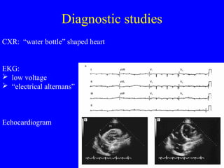 Diagnostic studies
CXR: “water bottle” shaped heart
EKG:
 low voltage
 “electrical alternans”
Echocardiogram
 