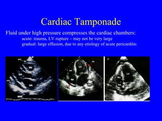 Cardiac Tamponade
Fluid under high pressure compresses the cardiac chambers:
acute: trauma, LV rupture – may not be very large
gradual: large effusion, due to any etiology of acute pericarditis
 