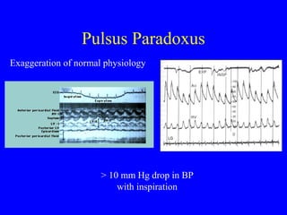 Pulsus Paradoxus
Exaggeration of normal physiology
> 10 mm Hg drop in BP
with inspiration
 