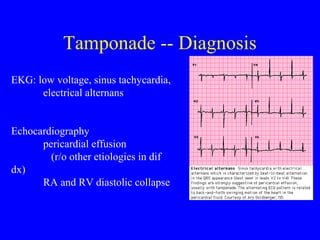 Tamponade -- Diagnosis
EKG: low voltage, sinus tachycardia,
electrical alternans
Echocardiography
pericardial effusion
(r/o other etiologies in dif
dx)
RA and RV diastolic collapse
 