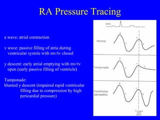 RA Pressure Tracing
a wave: atrial contraction
v wave: passive filling of atria during
ventricular systole with mv/tv closed
y descent: early atrial emptying with mv/tv
open (early passive filling of ventricle)
Tamponade:
blunted y descent (impaired rapid ventricular
filling due to compression by high
pericardial pressure)
 