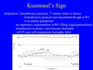 Kussmaul’s Sign
inspiration: ↓intrathoracic pressure, ↑ venous return to thorax
↓intrathoracic pressure not transmitted though to RV
⇒ no pulsus paradoxus!
no inspiratory augmentation of RV filling (rigid pericardium)
intrathoracic systemic veins become distended
⇒JVP rises with inspiration (normally falls)
 